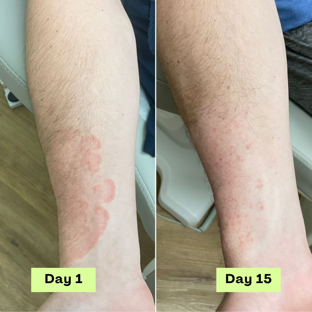 Loravey® Antifungal Relief Soap Bar