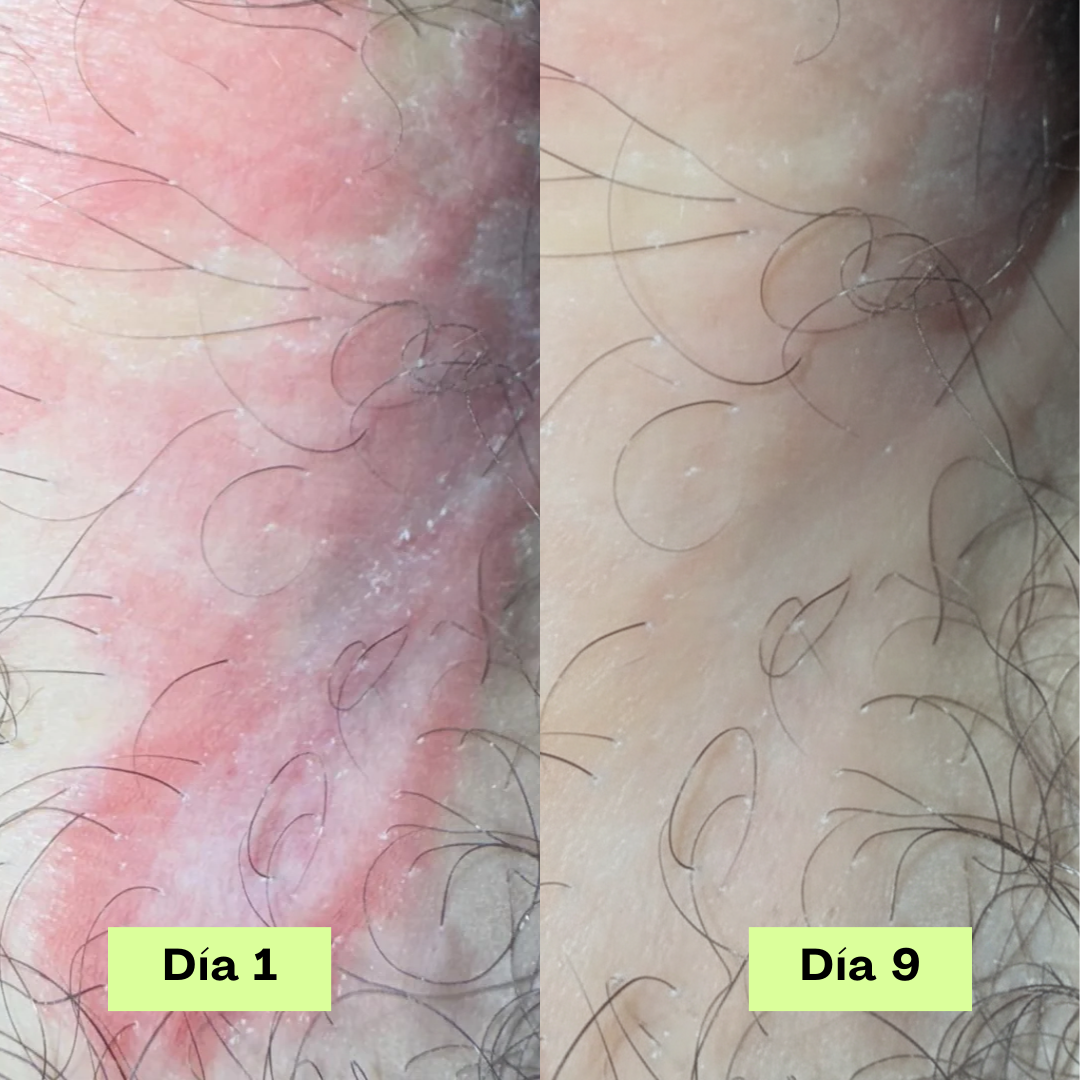Jabón Antifúngico Loravey® Barra Para Alivio de Tiña Inguinal