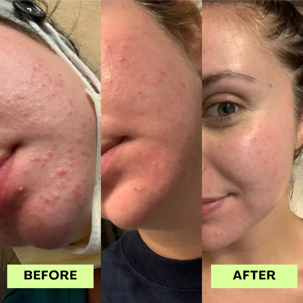 Loravey® AntiFungal Acne Soap Bar