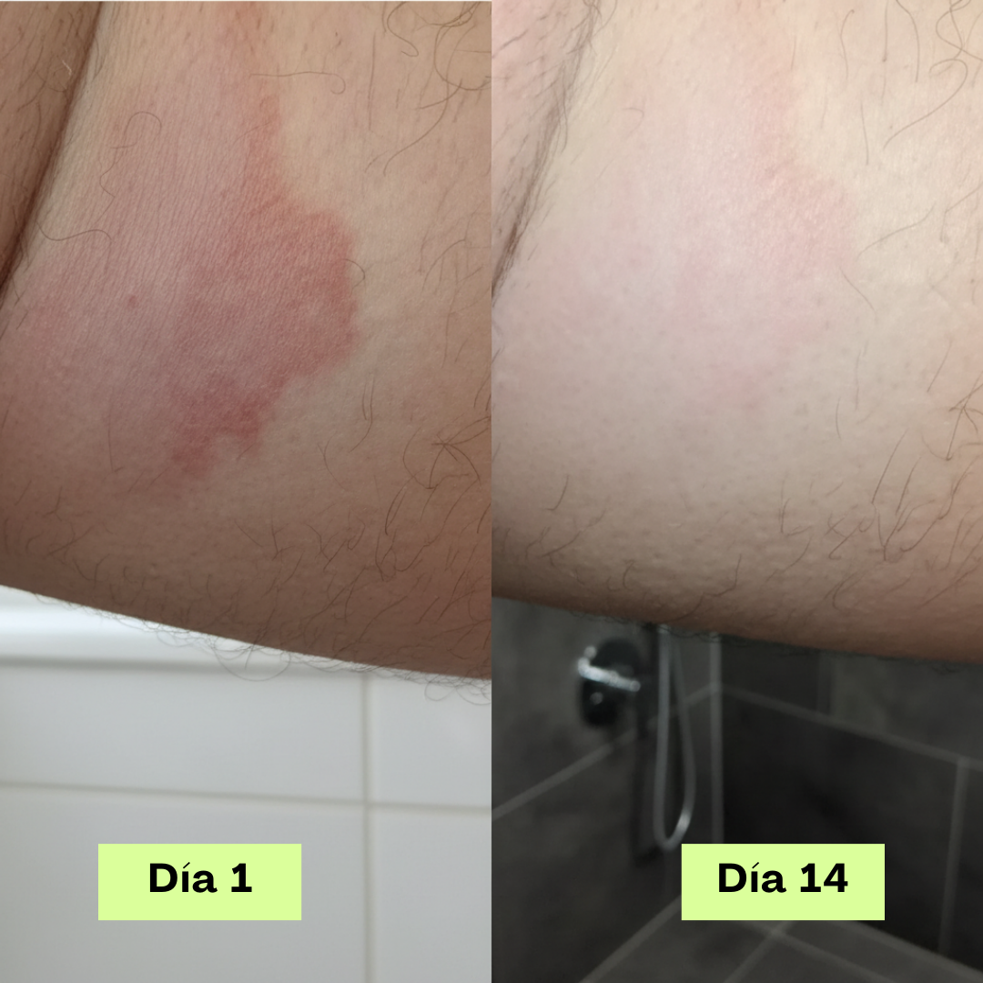 Jabón Antifúngico Loravey® Barra Para Alivio de Tiña Inguinal