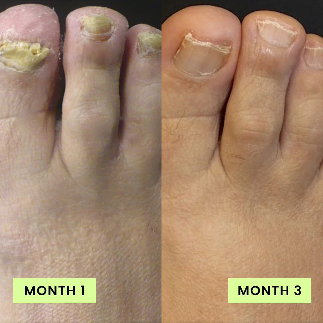 Loravey Nail Care Pen - 25% Undecylenic Acid