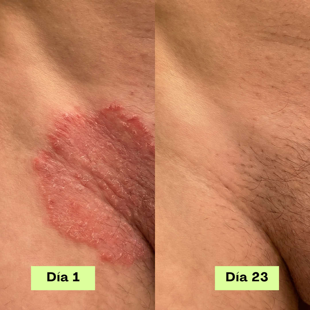 Jabón Antifúngico Loravey® Barra Para Alivio de Tiña Inguinal