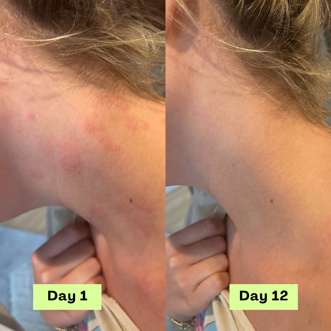 Loravey® Antifungal Relief Soap Bar