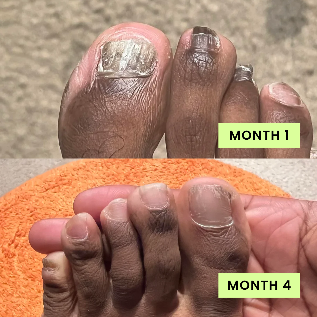 Loravey Nail Care Pen - 25% Undecylenic Acid