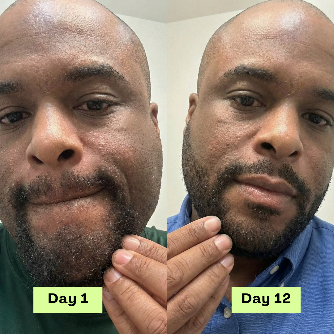 Loravey® AntiFungal Relief Soap Bar