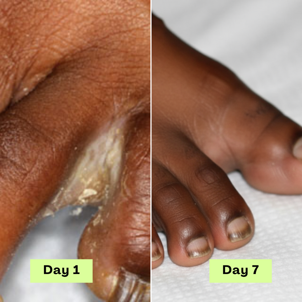 Loravey® AntiFungal Relief Soap Bar