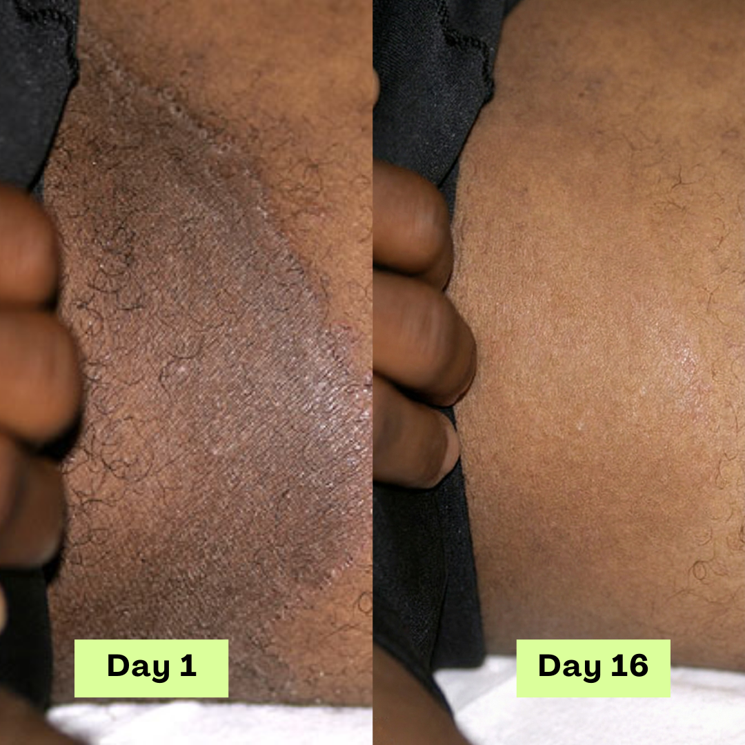 Loravey® Jock Itch Relief Soap Bar