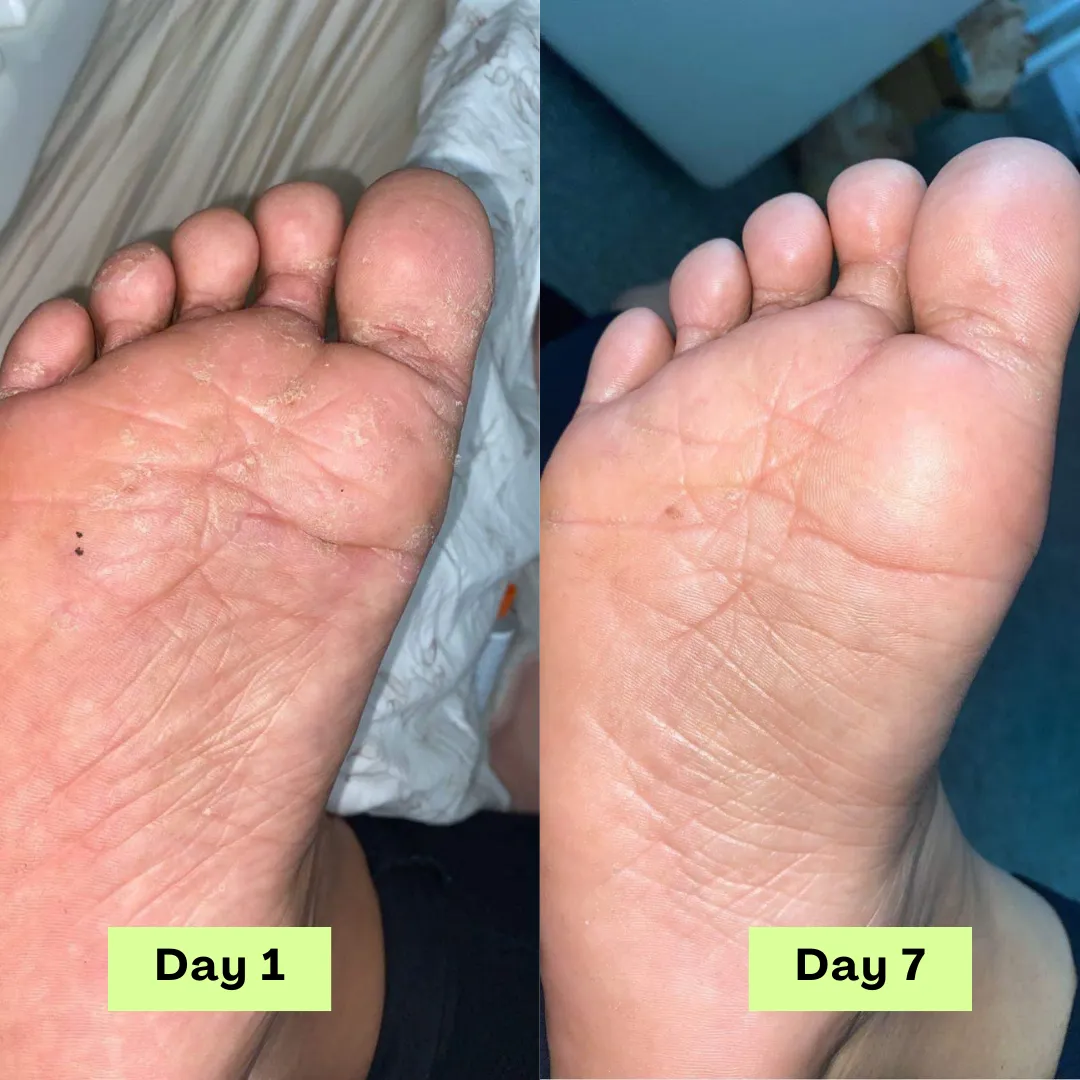 Before and after photos of a customer's foot
