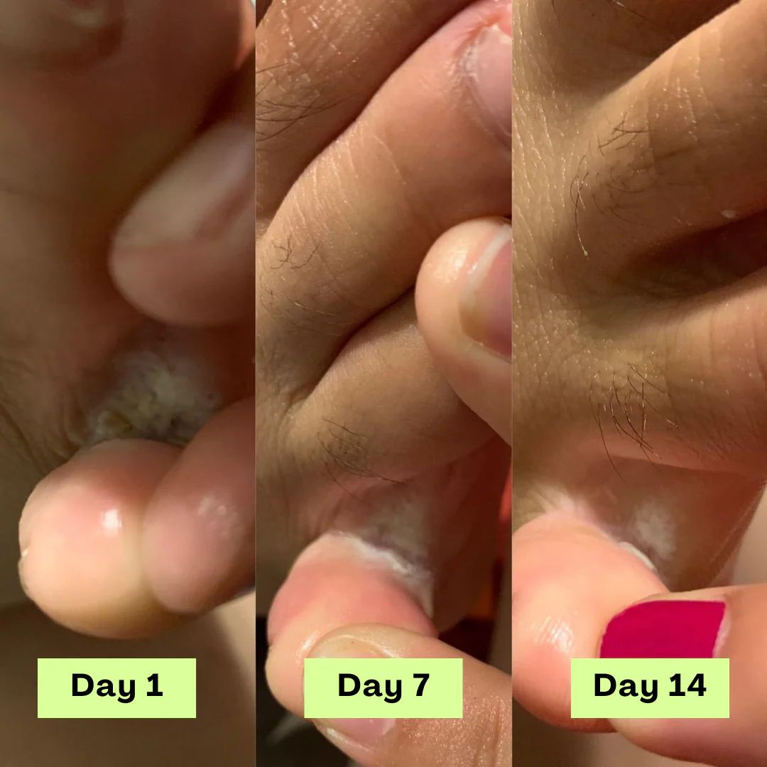 Before and after photos of a customer's toenails
